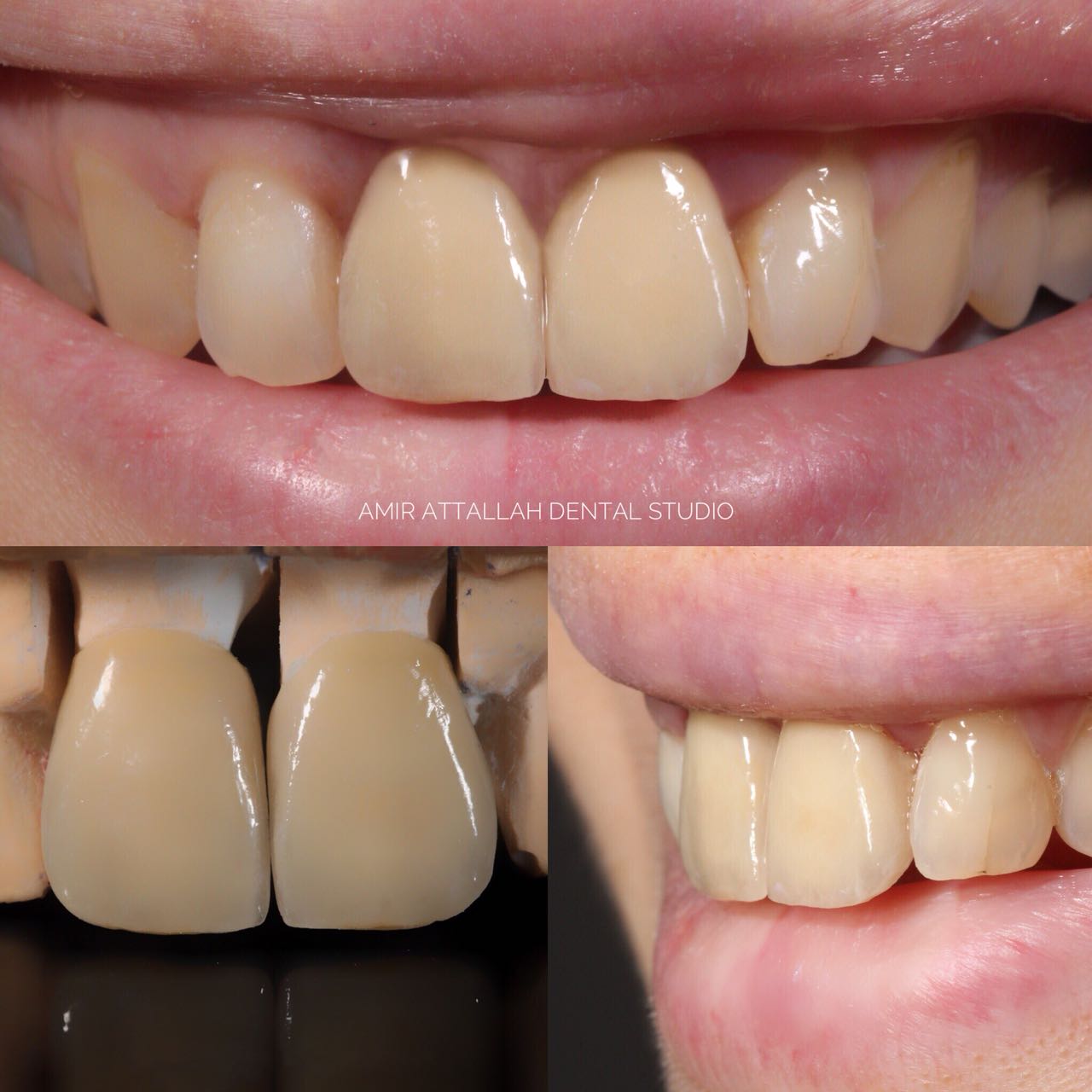 Couronnes en ceramique Feldspathic sur modele dentaire
