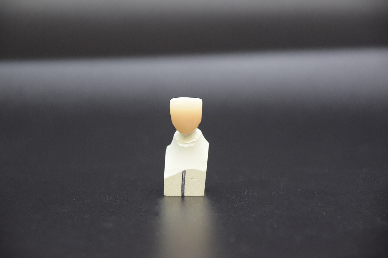 Couronne dentaire zircone - exemple anatomique