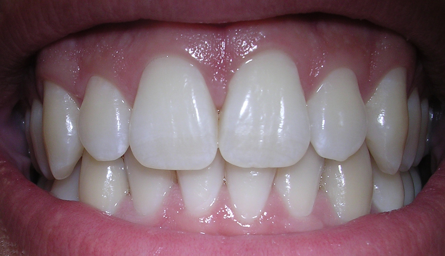 Dents permanentes humaines - anatomie externe