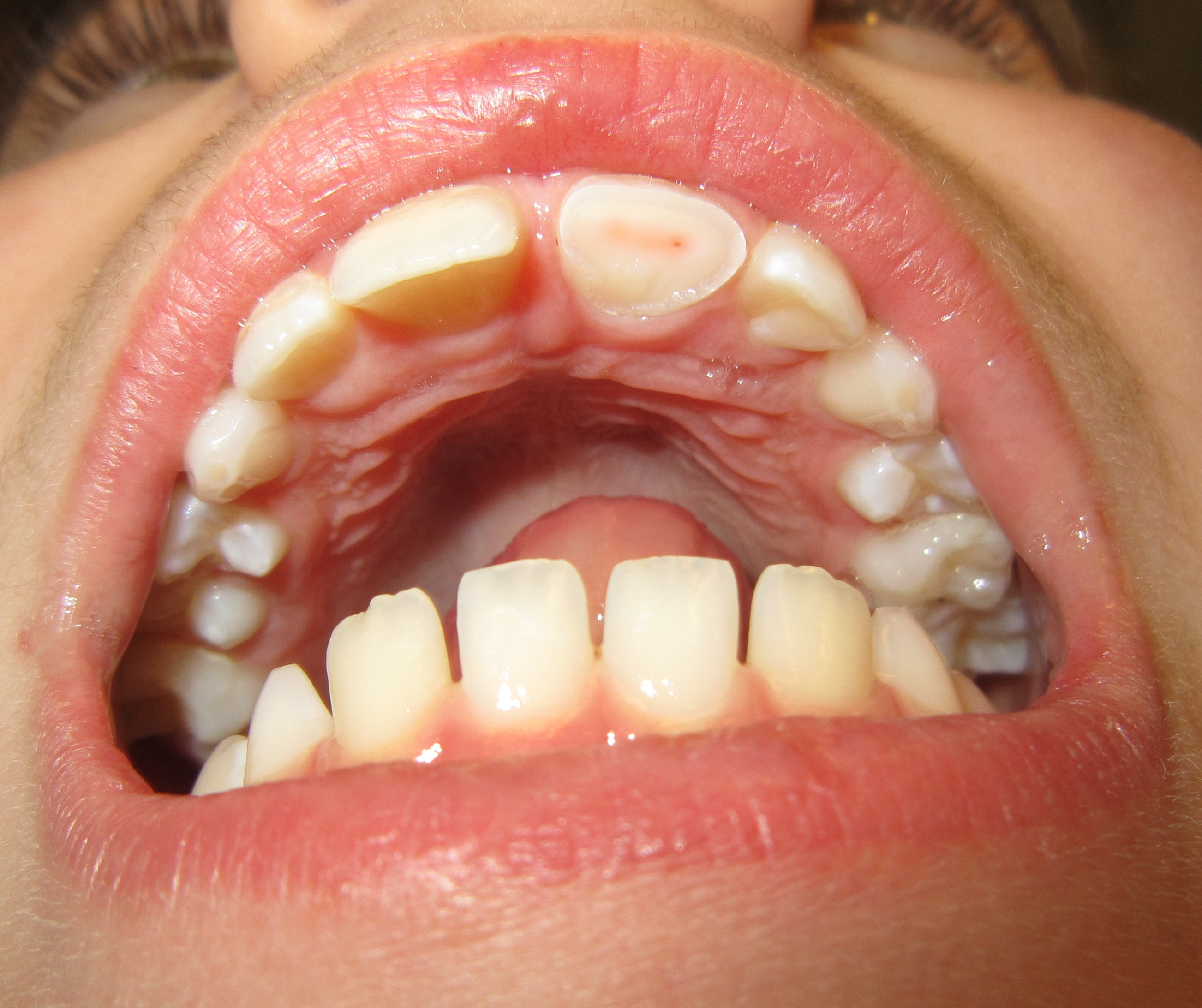 Dent traumatisee - imagerie de suivi