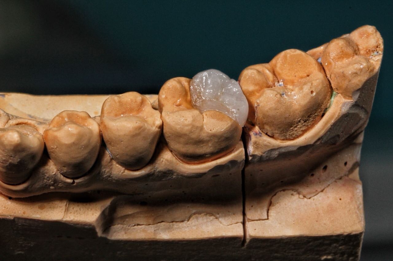 Inlay ceramique IPS emax sur modele