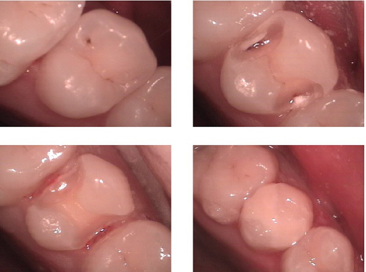 Restauration en composite tooth-colored