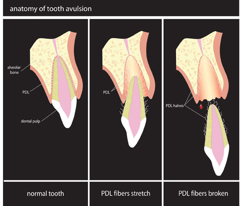 Avulsion dentaire - dent completement arrachee de son alveole