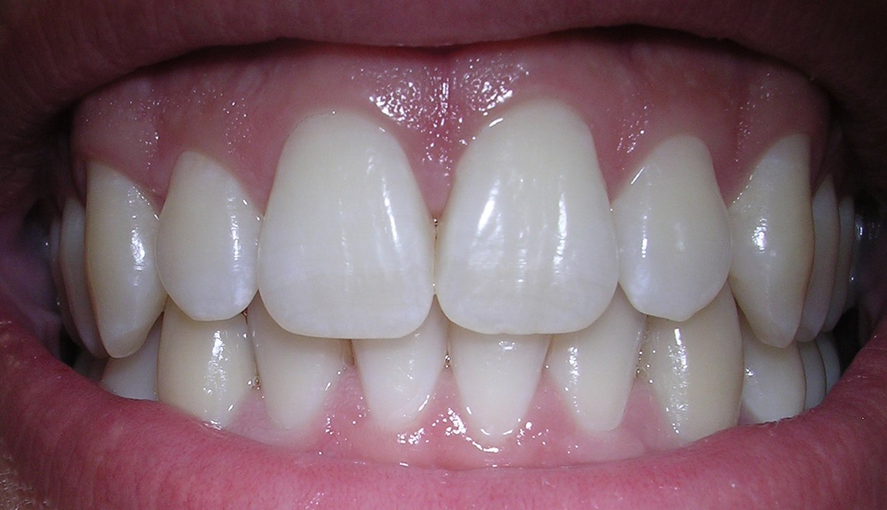 Anatomie d'une dent de lait et germe de la dent definitive